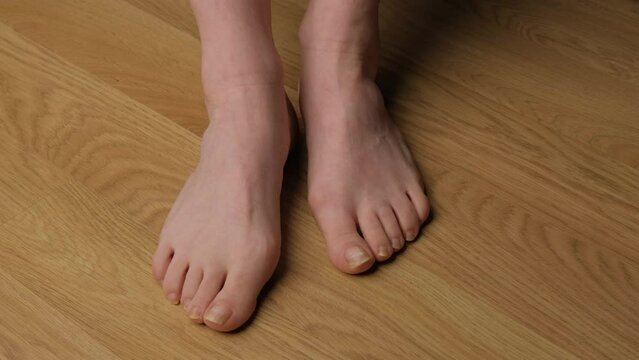 Close-up of a woman's feet with hallux valgus.
