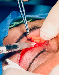 photo of suturing the upper eyelid after blepharoplasty surgery