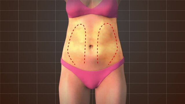 Waist fat reduction medical animation