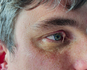 Obraz premium Zoom auf entzündetes Gerstenkorn am menschlichen Auge