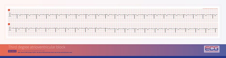 Third degree atrioventricular block in young women may be congenital, with the block located on the atrioventricular node or above bifurcation of the His bundle.
