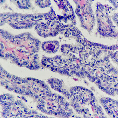 Obraz premium Camera photo of papillary thyroid carcinoma showing psammoma bodies, magnification 400x, photograph through a microscope