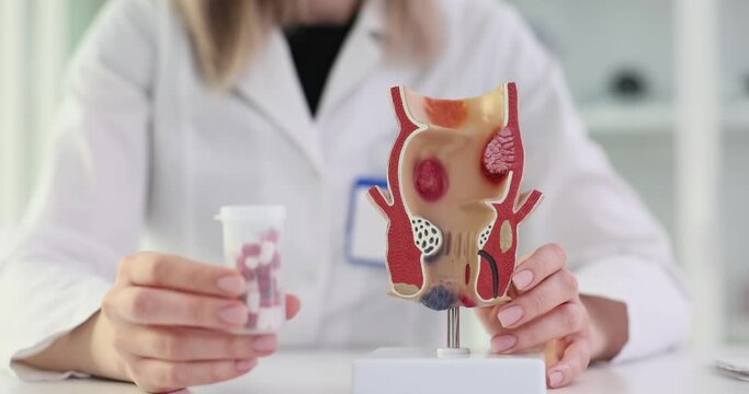 Doctor model of the rectum with inflamed vascular structures and pills.