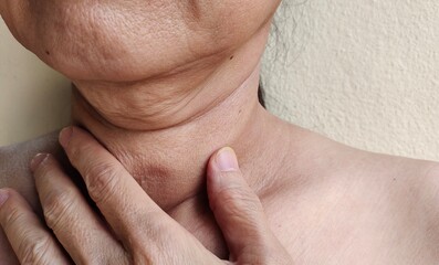 close up of a woman holding the flabbiness adipose sagging skin under the chin, neck wattle and...