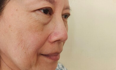 portrait the wrinkle and Flabby skin beside the eyelid, swelling and loose under the eyes, dark spots and blemish, Flabbiness and creases on the face of the woman, health care and beauty concept.