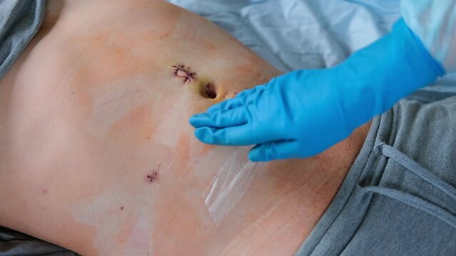 Hands of medic or nurse in blue gloves examining a fresh suture on a man&rsquo;s stomach after laparoscopy surgical removal of appendicitis. Doctor examines of the patient. Man's belly with medical stitches