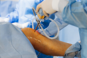 02.01.2024 Vinnytsia, Ukraine: two trauma surgeons work on a patient's knee joint reconstruction on...
