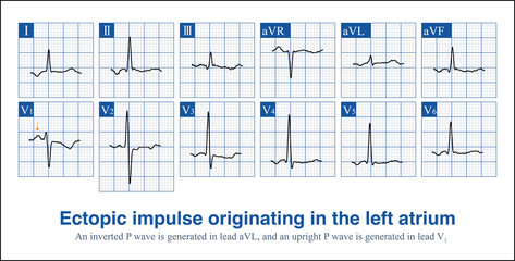 When ectopic impulses from the anterior wall of the right atrium produce a completely negative P wave in lead V1, the posterior wall ectopic impulse produces a positive and negative biphasic P wave.
