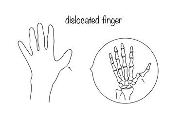 Dislocated thumb