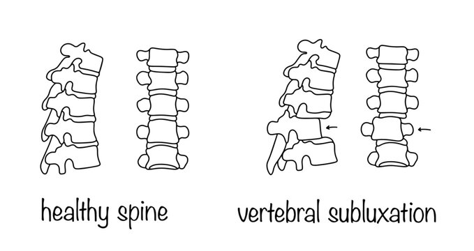Vertebral subluxation