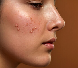 acne close up of a person female