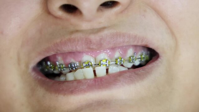 young girl showing her teeth bracing to dentist from flat angle