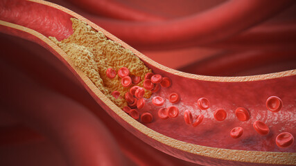 Obraz premium High Blood Cholesterol, Thickened Arteries and Veins, Red Blood Cells, 3d illustration.