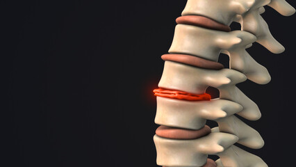 Degenerative disc in the human spine