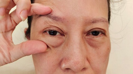 Portrait the fingers holding the flabbiness and wrinkle beside the eyelid, eyes problem, Flabby...