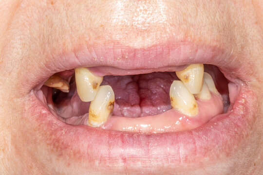 Dental front view of an adult woman occlusion teeth arches open lips. Teeth loss on anterior and posterior sector with remaining canines, a decayed upper molar and lower left side premolars.