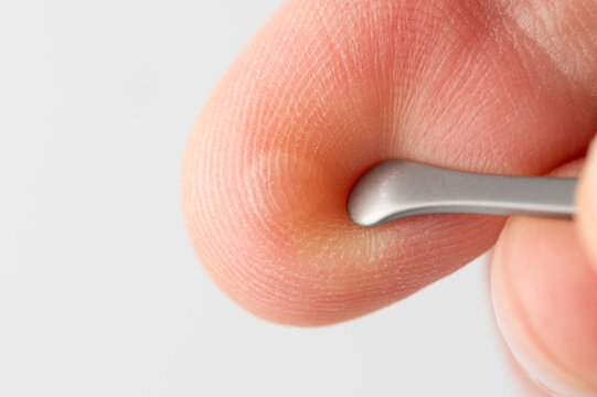 Damaged skin on finger with blister