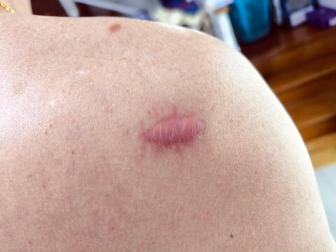 keloid scar on the her shoulder of a man