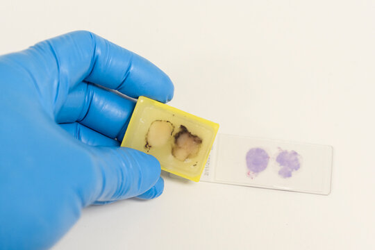 Scientist wear blue glove holding paraffin human tissue block and out of focus slide on white background.Doctor is examining histological sample, a biopsy in the laboratory of cancer research.