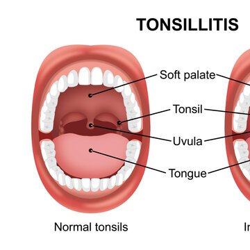 Tonsillitis throat infection inflamed tonsil illustration