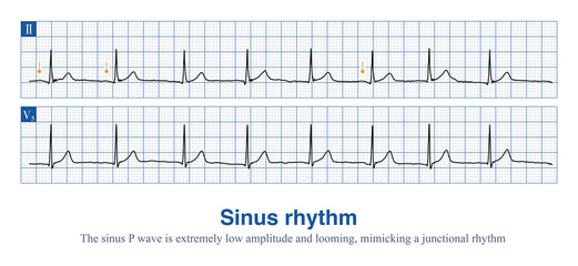 Sometimes, the P wave amplitude of sinus rhythm is so low that it is close to an isopotential and can easily be mistaken for a borderline rhythm.
