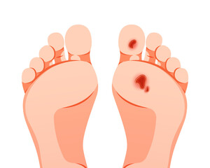 Diabetic foot ulcers vector isolated on white background.