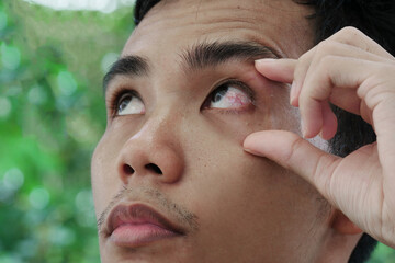 Man holding his red eyes and having blepharitis, Conjunctivitis condition