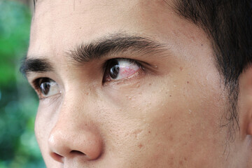The man's eyes were red and had blepharitis, a conjunctivitis condition