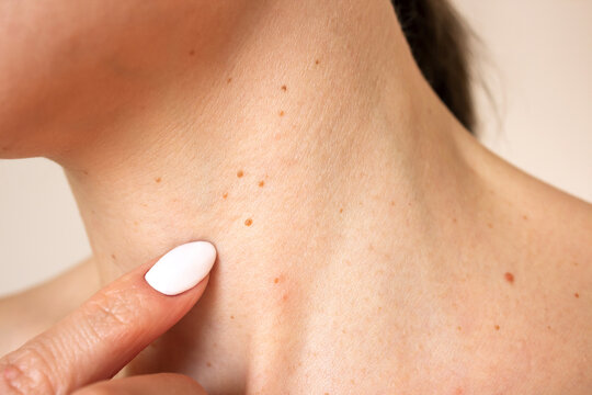 a photo of the neck of a young Caucasian woman suffering from a multitude of brown growths on the skin, papillomas. Skin diseases. Human papillomavirus. Laser removal of papillomas