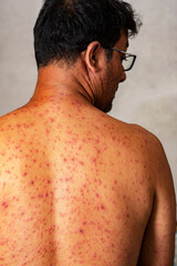 closeup a man back who having varicella blister or chickenpox or Monkeypox new disease dangerous over the world.