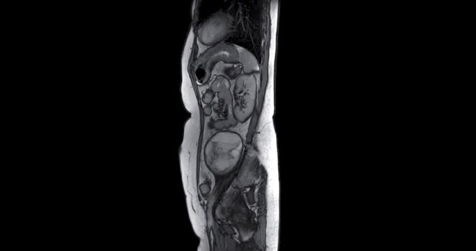MRI Whole abdomen showing Cystic retroperitoneal dedifferentialed liposarcoma.