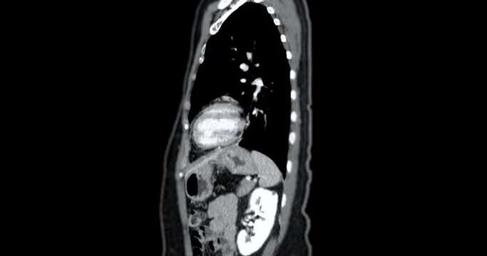 CT Abdomen show a retroperitoneal mass with a peripheral fatty component with thin septa and poorly defined solid-appearing areas with no clear demarcation between them and fat.