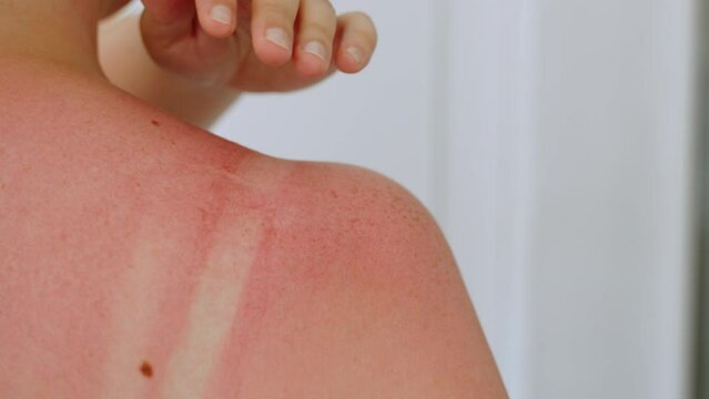 Close-up of shoulder with red and irritated skin after sunburn. Unrecognizable woman removes her bra strap and touches inflamed skin with her hand. Burns tender pale skin without protection.