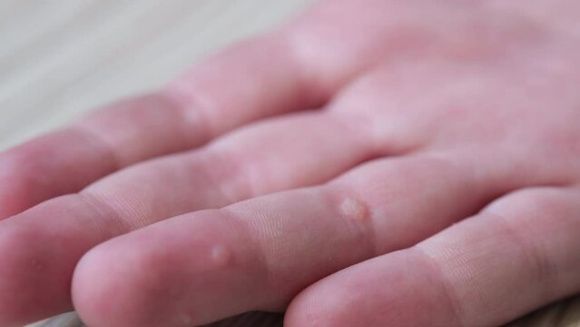 Child hand with warts. Pediatric dermatology concept. Papillomavirus. 