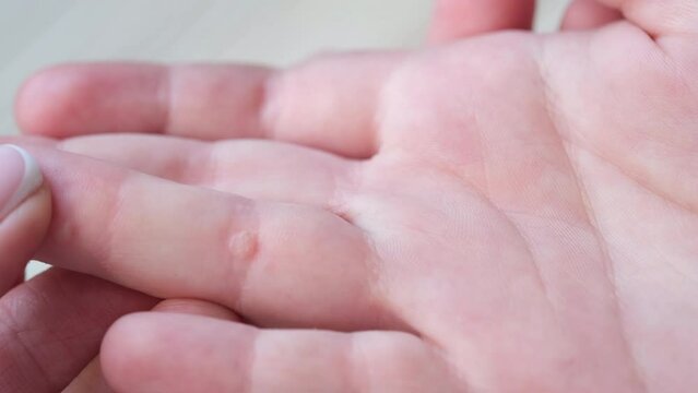 Boy's  hand with warts. Pediatric dermatology concept. Papillomavirus.	
