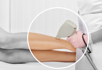 Elos epilation hair removal procedure on a woman’s body. Beautician doing laser rejuvenation on...