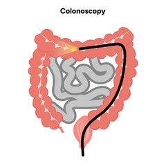 Colonoscopy 