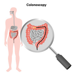 Colonoscopy 