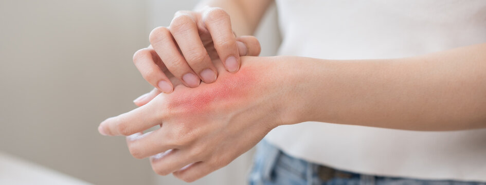 Dermatology asian young woman allergy, allergic reaction from atopic, insect bite, scratching itchy back of hand, red spot or rash of skin. Healthcare treatment of beauty. Isolated on white background