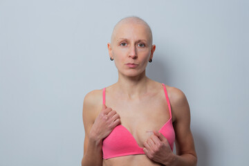 Bald woman after breast surgery in pink bra posing confidently