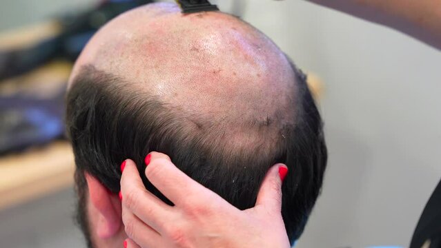 Hairdresser shaving the head of a bald man to attach a new wig