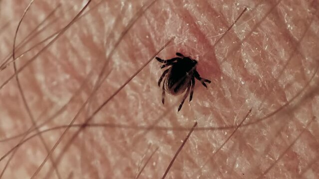 macro of a tick embedded in human skin dangerous insect bite with threat of lyme disease