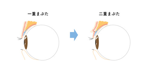 二重瞼