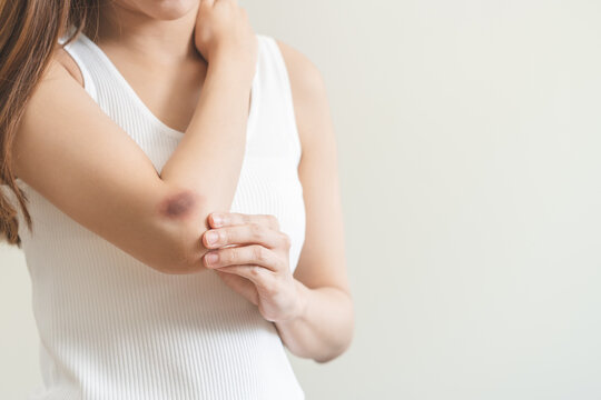 Close up of stain bruise wound on arm, contusion asian young woman, girl an accident fell down stairs, hand on elbow in healing injury by massage hematoma blood. Extravasation blue, purple on skin.