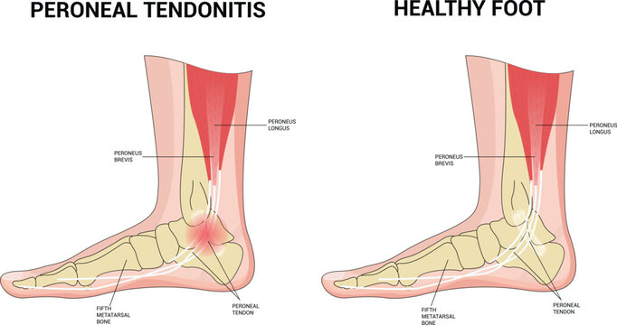 PERONEAL TENDONITIS Science Vector Illustration