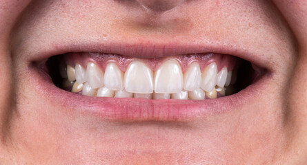 tooth restorations with emax ceramic crowns and veneers