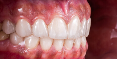 tooth restorations with emax ceramic crowns and veneers
