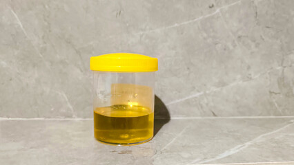 urine sample analysis in a jar in hand. Urology and kidney diseases and urinary tract infections...