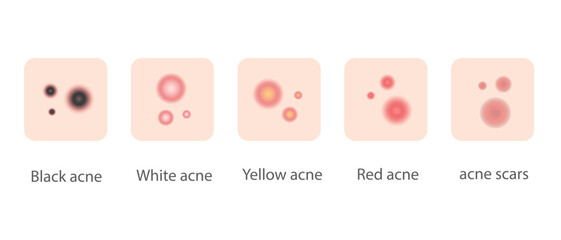 Illustration of various types of acne for web design and banners.