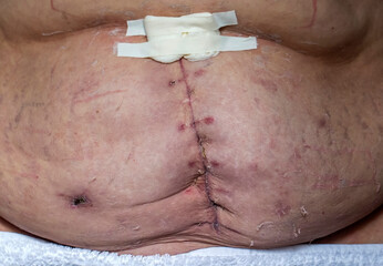 A stitch on the stomach after removal of the uterus and ovaries